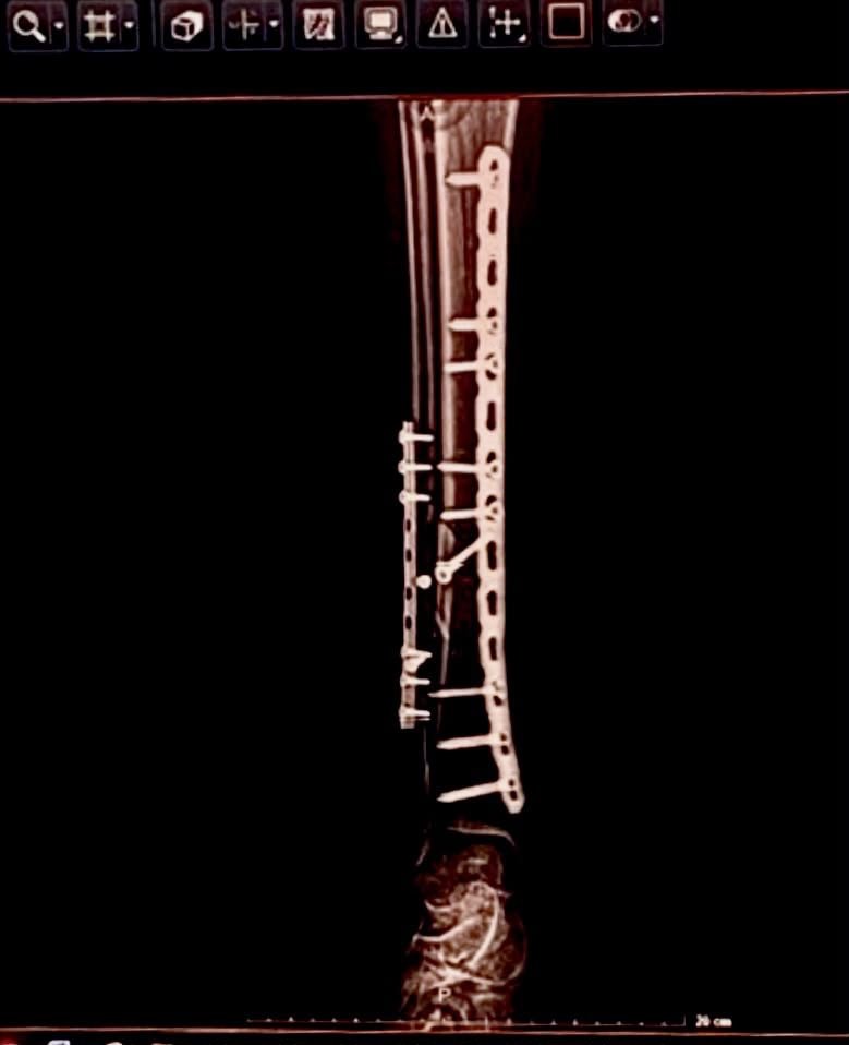 Help Brandon Get Urgent Surgery for His Leg campaign photo, 7 of 8