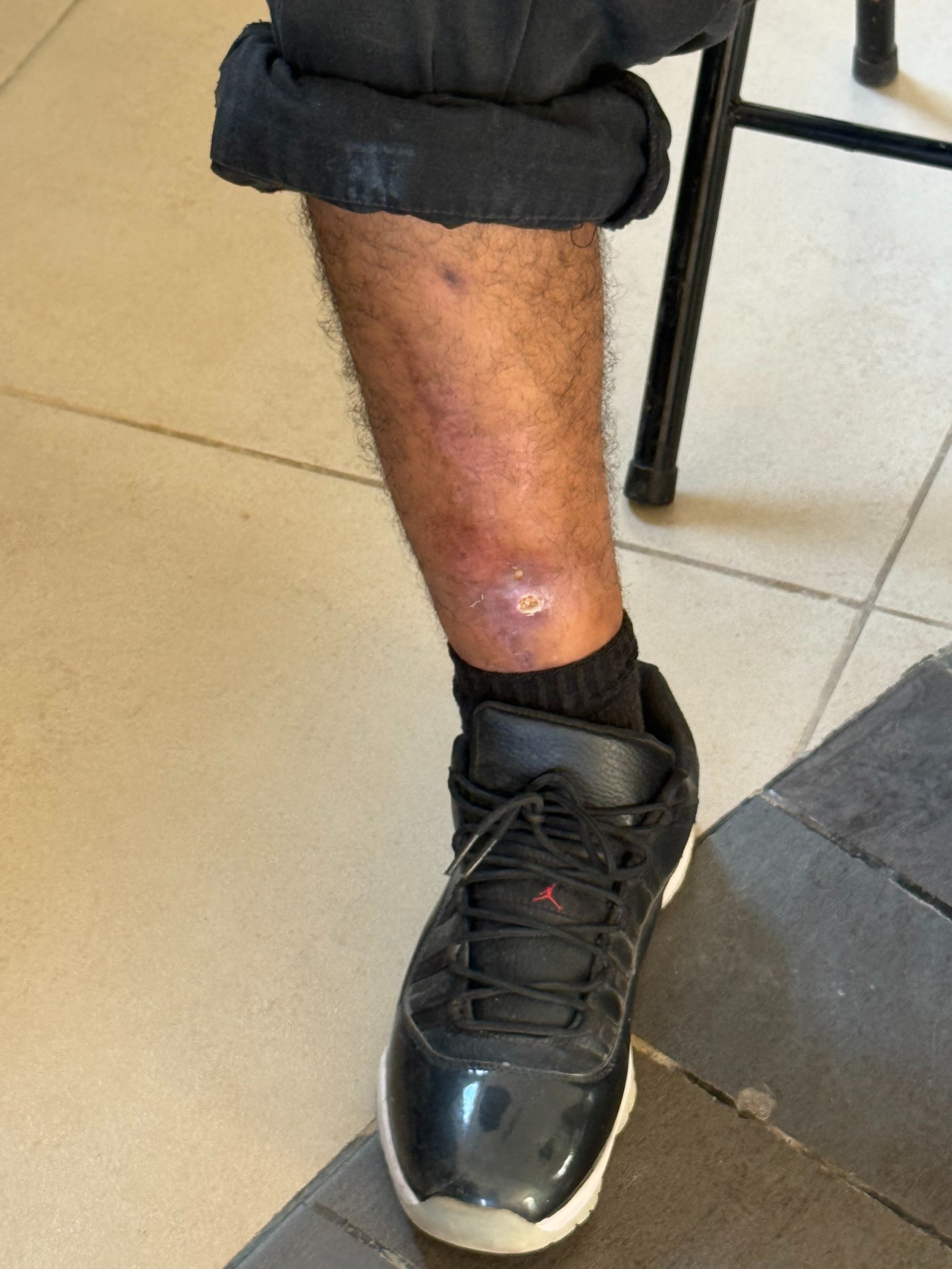 Help Brandon Get Urgent Surgery for His Leg campaign photo, 5 of 8