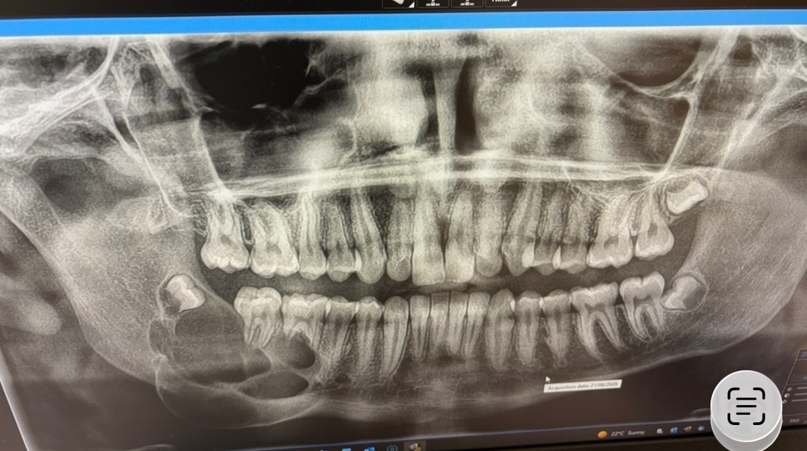 Help us fight Matt’s Ameloblastoma Tumour battle campaign photo, 7 of 8