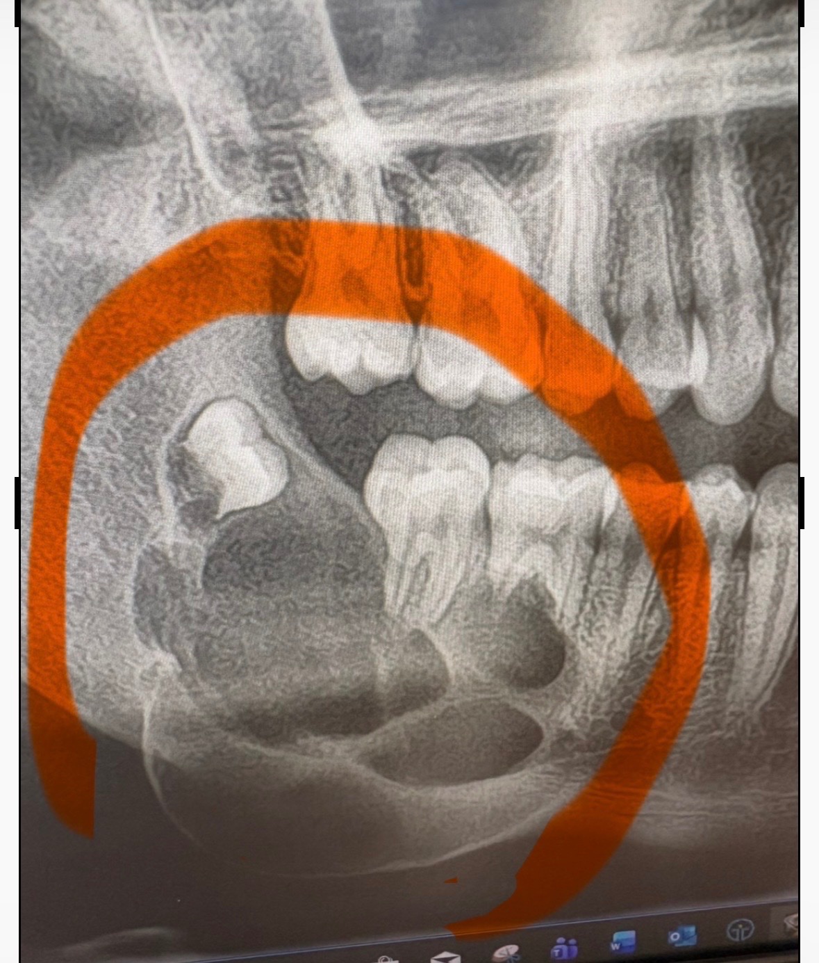 Help us fight Matt’s Ameloblastoma Tumour battle campaign photo, 2 of 8