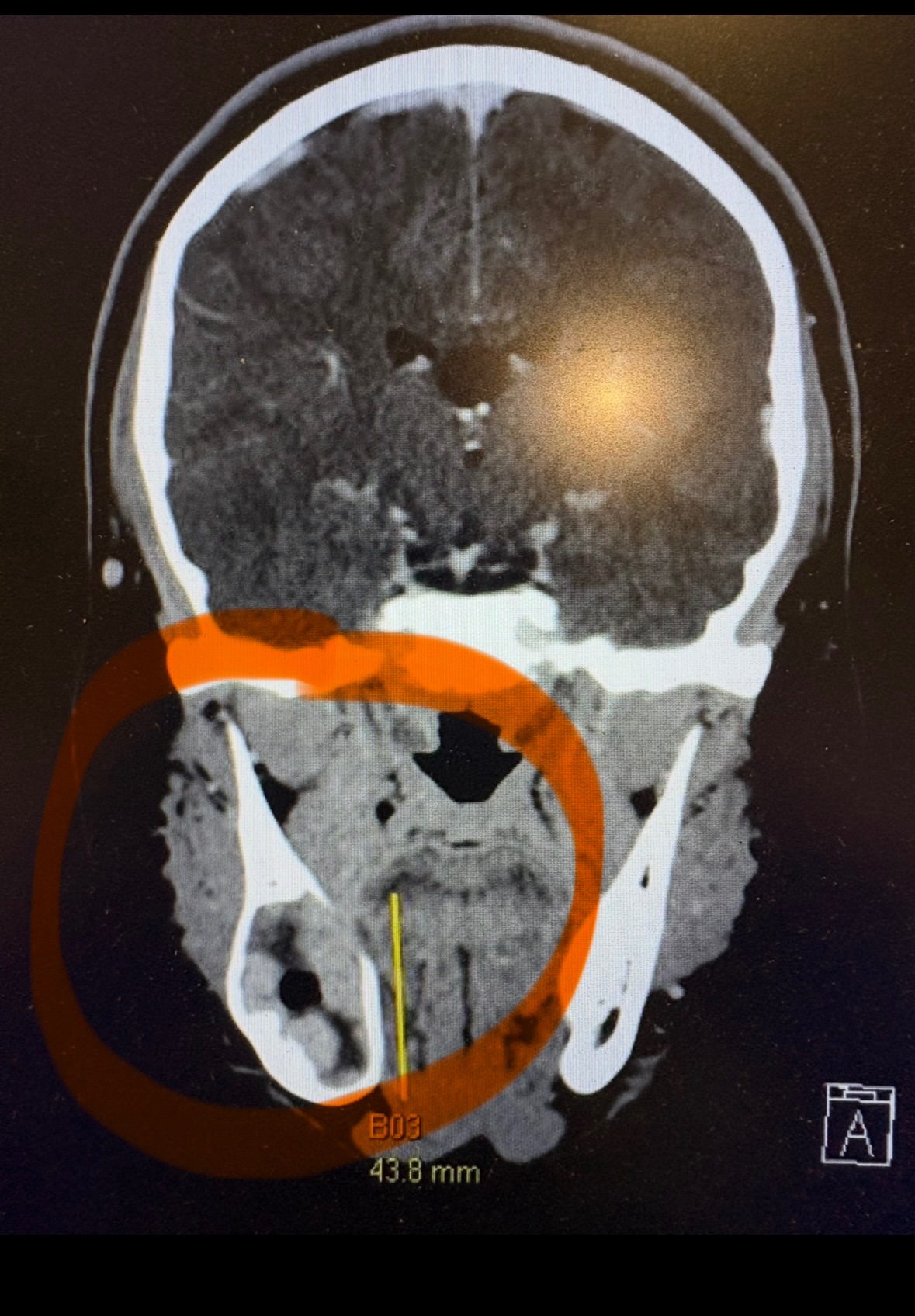 Help us fight Matt’s Ameloblastoma Tumour battle campaign photo, 4 of 8