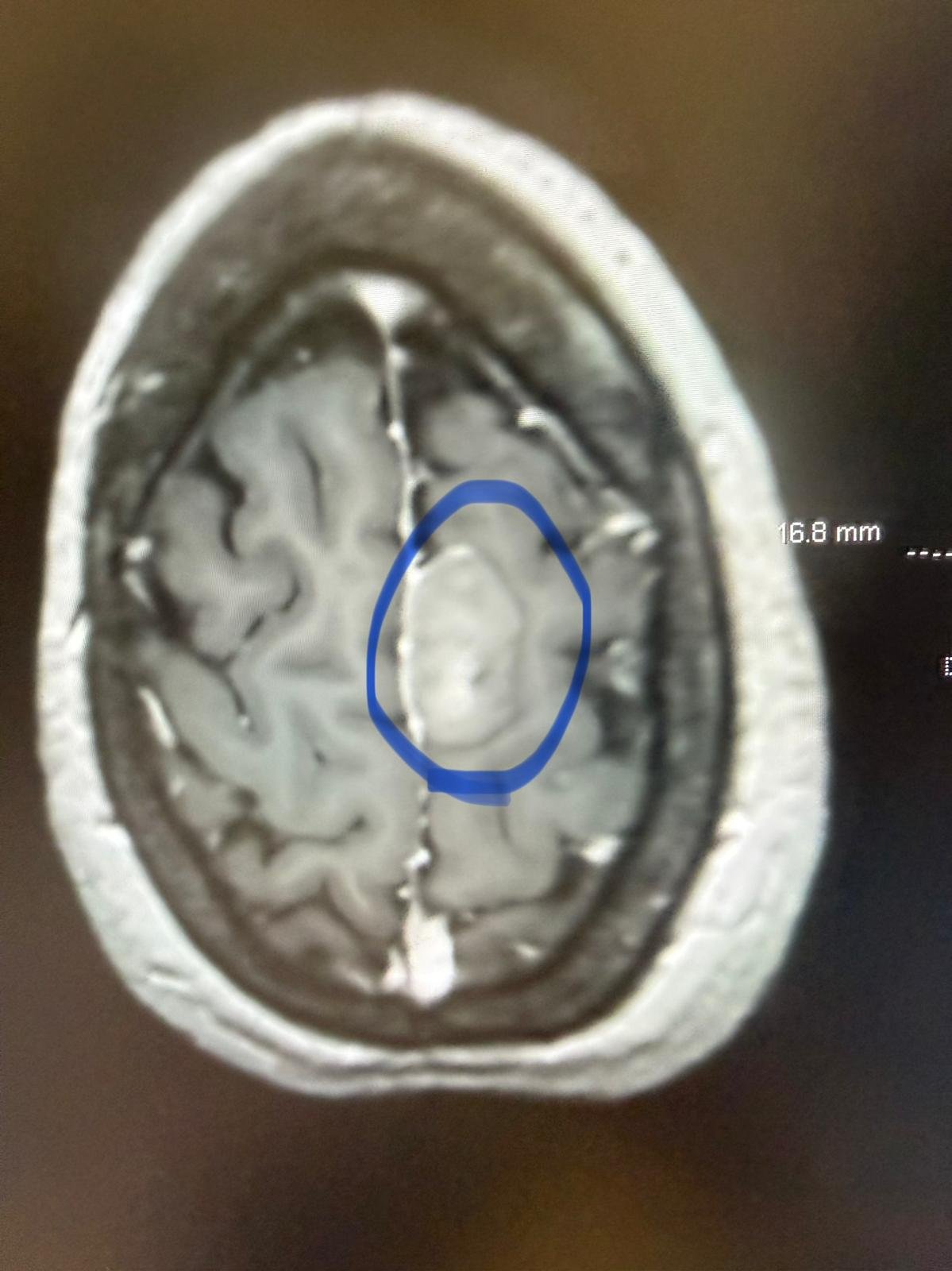 Foto de la recaudación de fondos Help Julissa Ortiz recover after 2 brain surgeries., 5 de 7