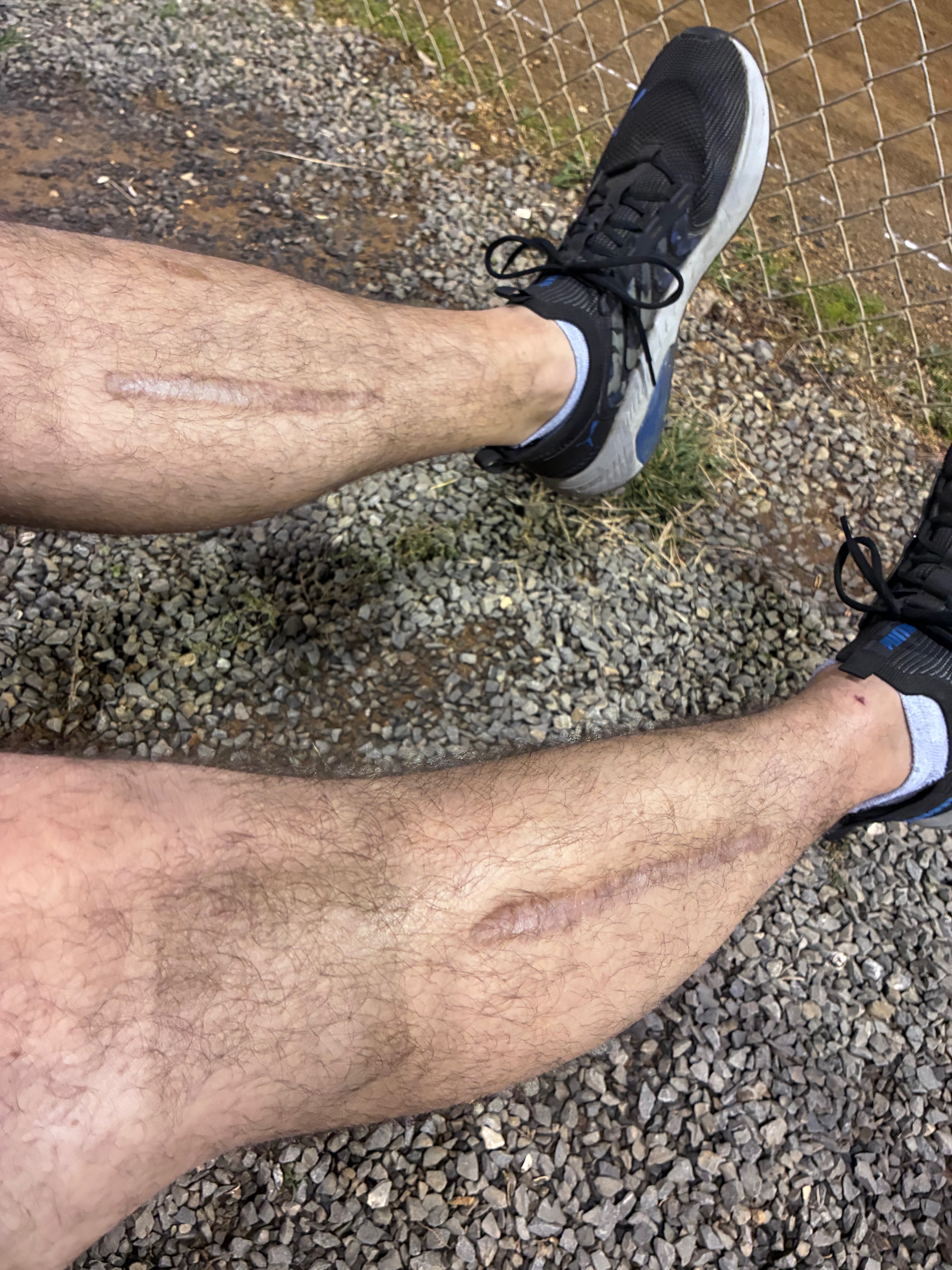 Fundraiser by Dustin Smith : Help severe neuropathy has changed my life