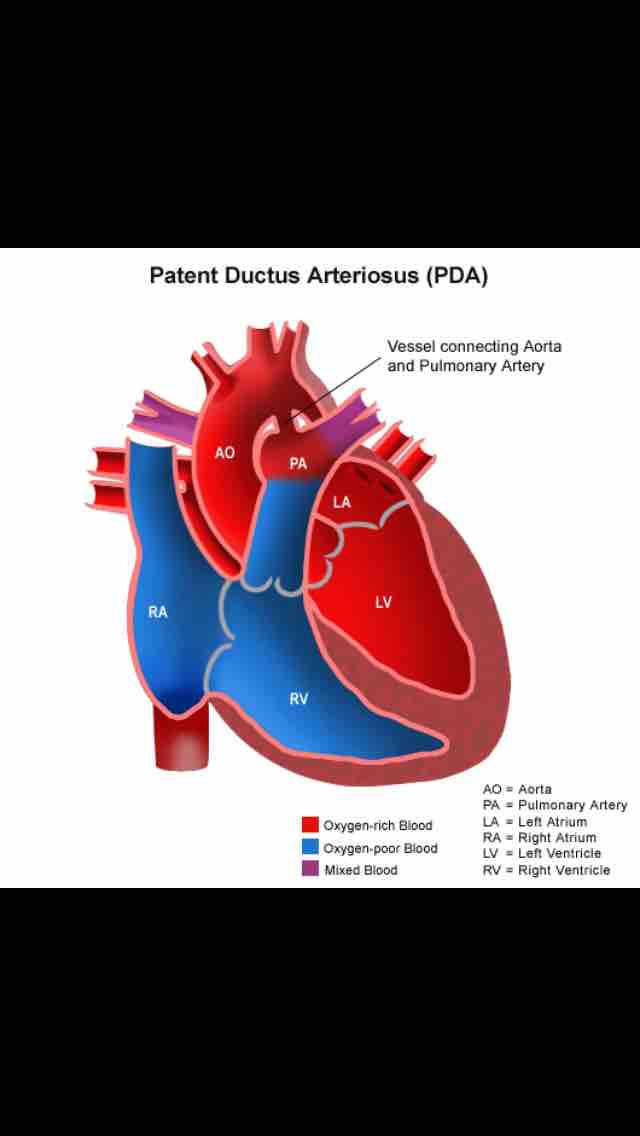 Plexus arteriosus. Атрезия легочной артерии. conus arteriosus правого желудочка.