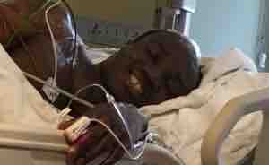 Brain tumor Glioblastoma photo