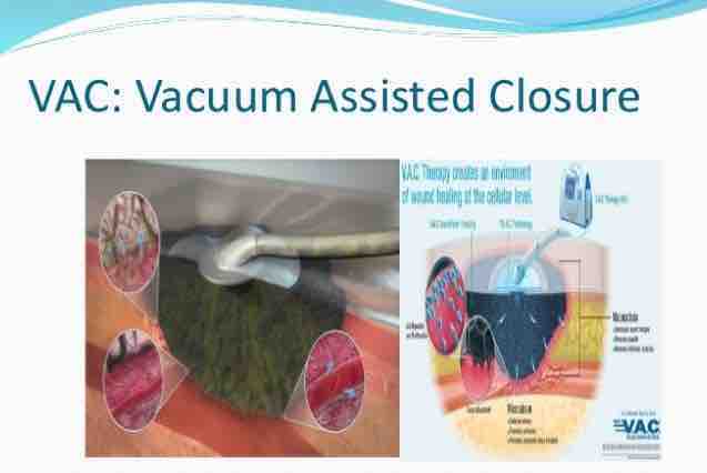 fundraiser by april gurrola wound vac coverage