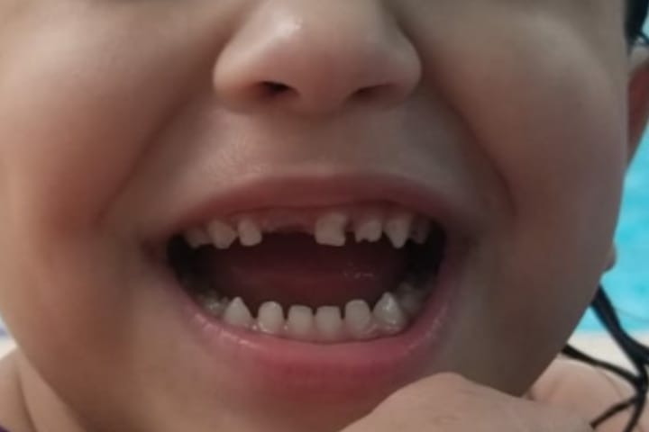 Premature Baby Teeth Enamel Newborn baby