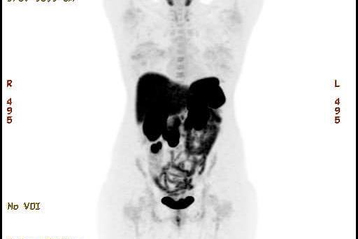 Healing but Dealing -Stage 4 Neuroendocrine Cancer photo