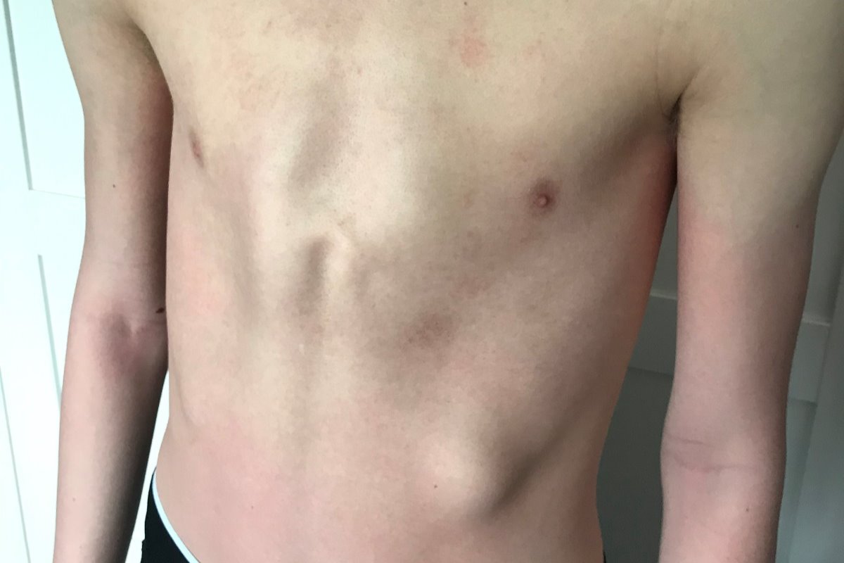 Fundraiser by Amanda Bradshaw ‘Lewis’ Chest Brace’ to correct Pectus