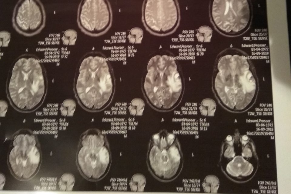 End Stage Glioblastoma What To Expect End Of Story