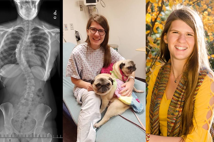 Fundraiser by Lisa Butler Vanhorenbeck : Victoria's ASC Scoliosis Surgery