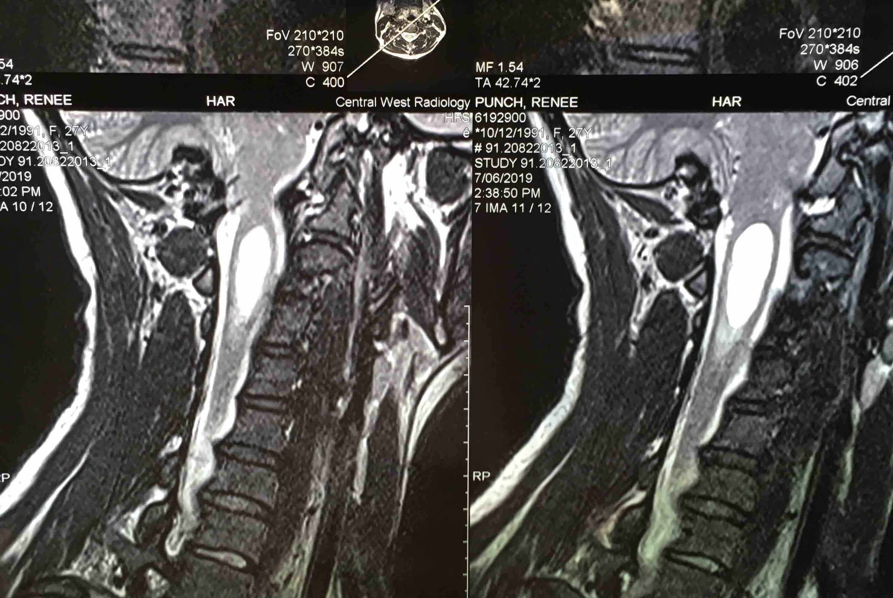 Fundraiser by Krystal Munro Brain Surgery