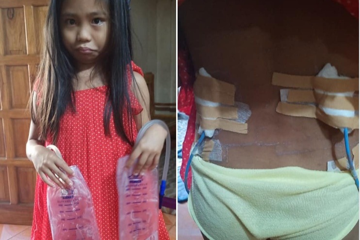 Charice Amaro's Kidney Transplant photo