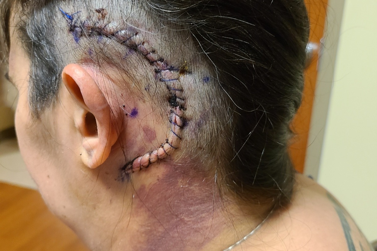 Barbs medical expenses photo