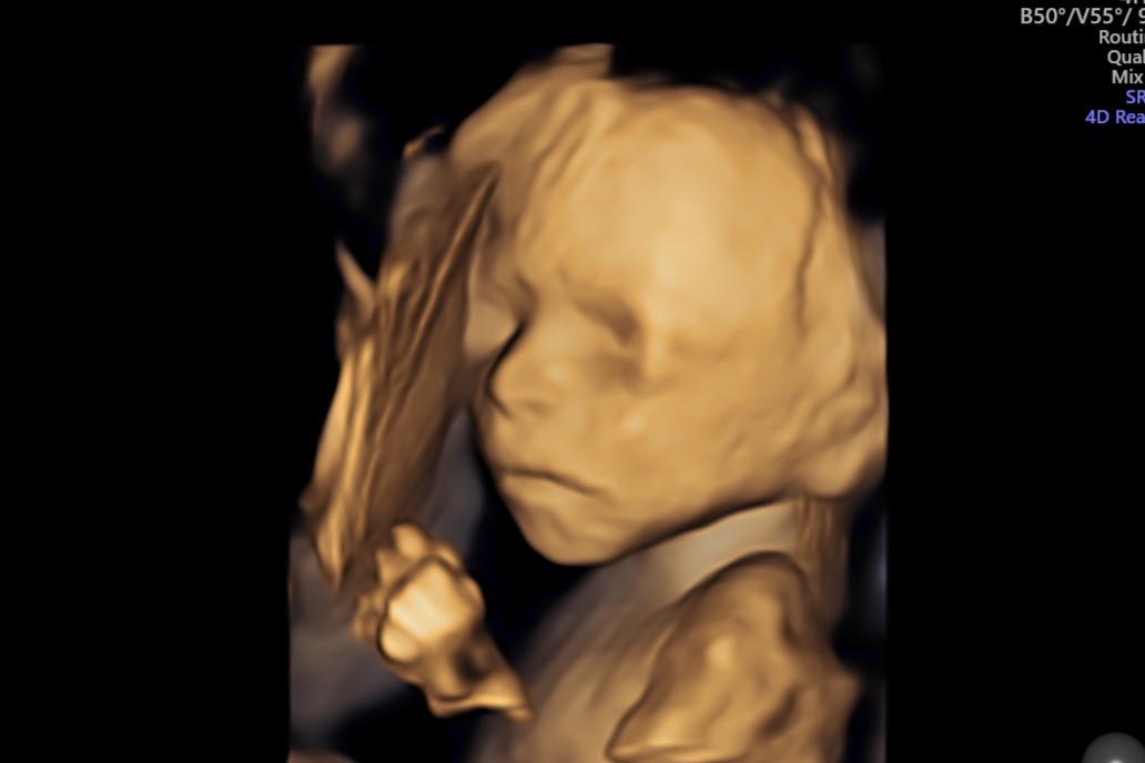 Beau Forvilly’s Gastroschisis Journey photo