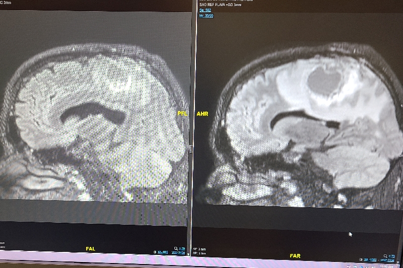 Ethan Moores Brain Cancer Treatment Expenses photo