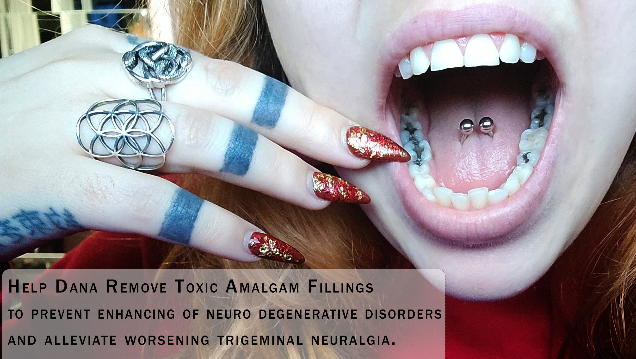 Fundraiser by Dana Graham Help Dana Remove 8 Toxic Amalgam Fillings