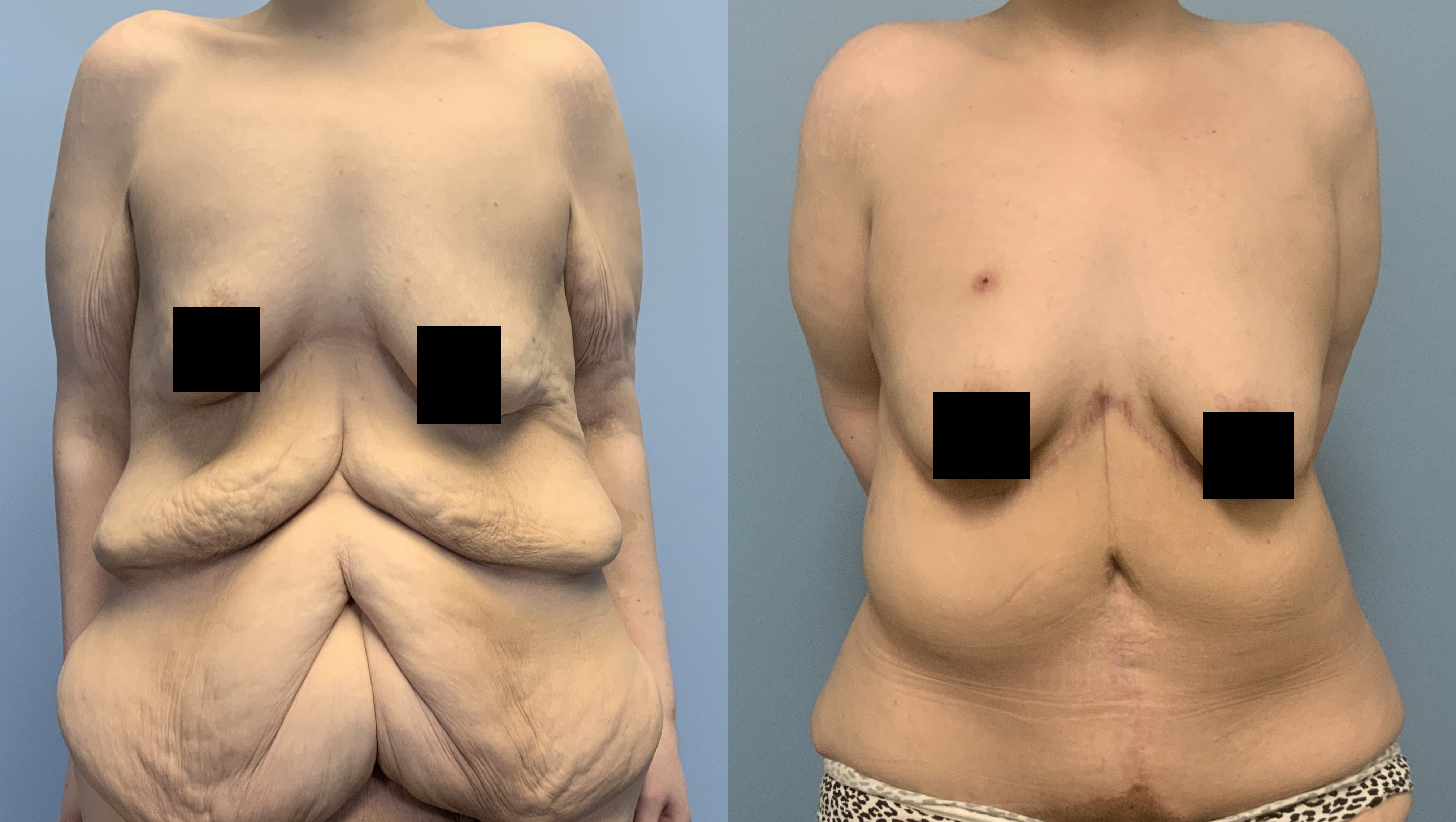 Revisions [Surgery] photo