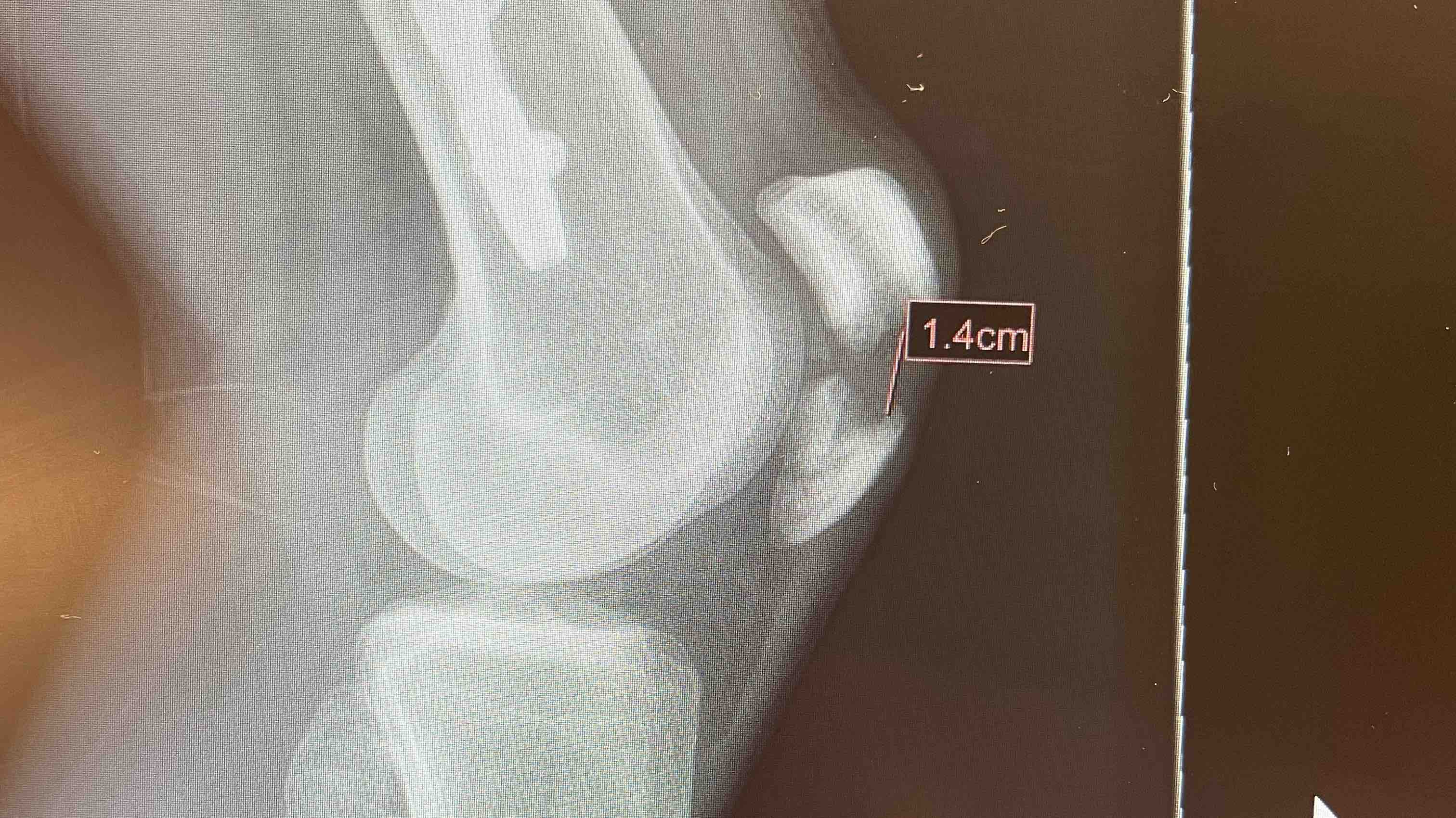 Matt’s recovery photo