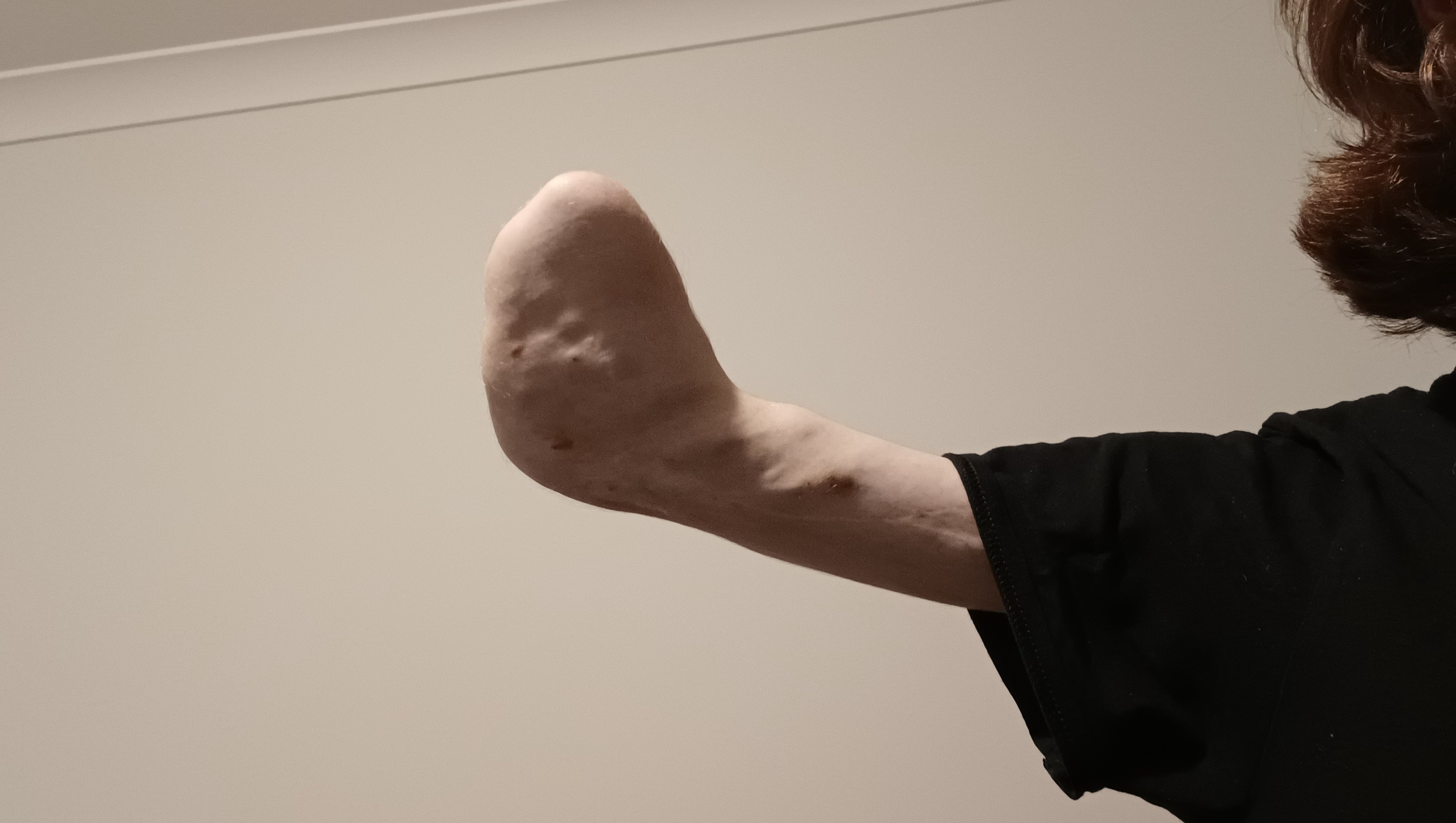 Please help an amputee afford a prosthesis photo