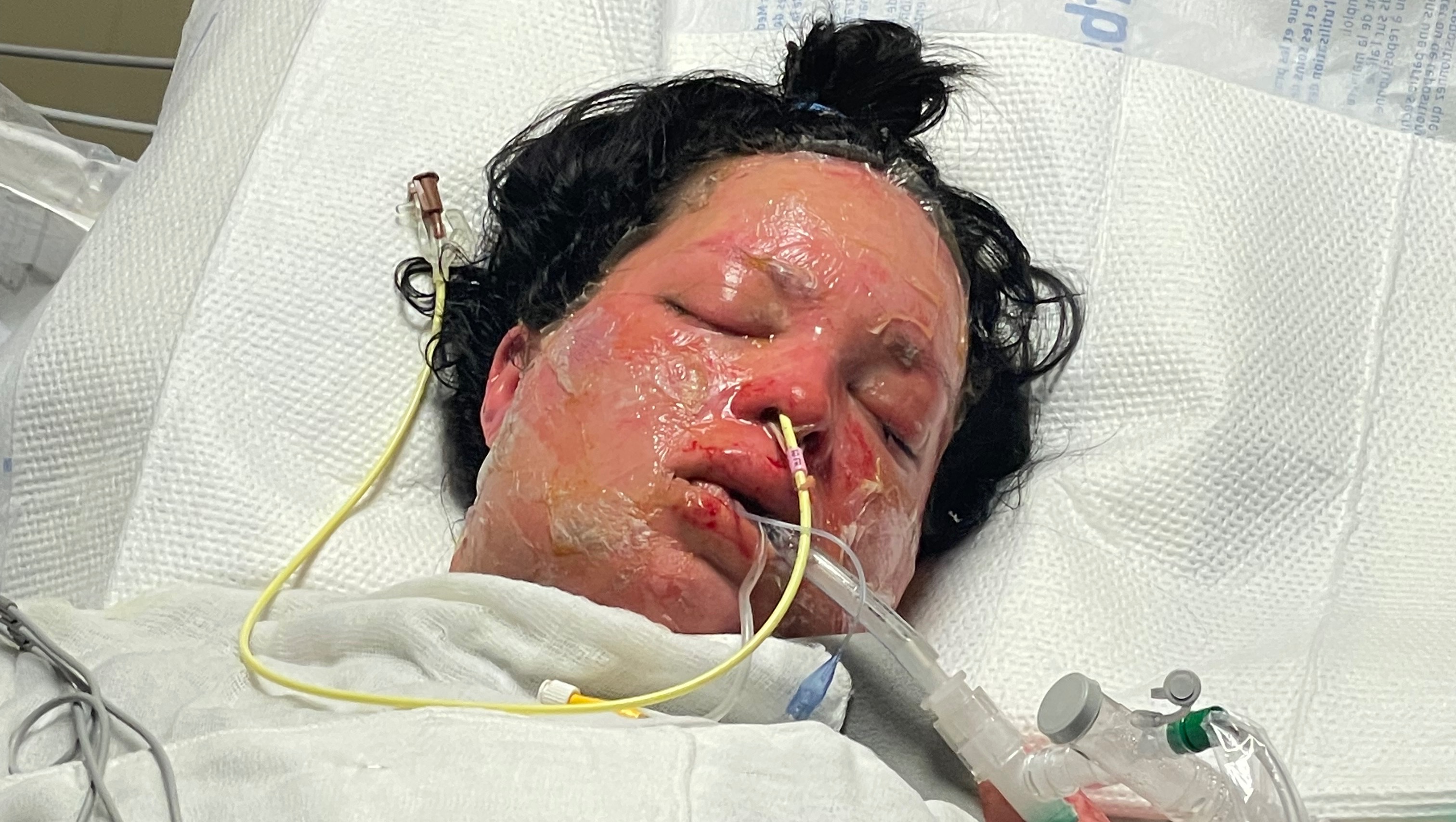 Gretchen’s Battle with SJS photo