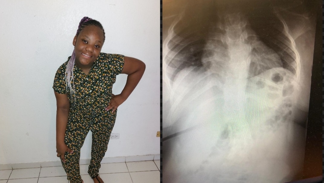Dencil Rolle Fundraiser for Dencil Rolle by Davinya Lightbourne : Spinal Surgery ...