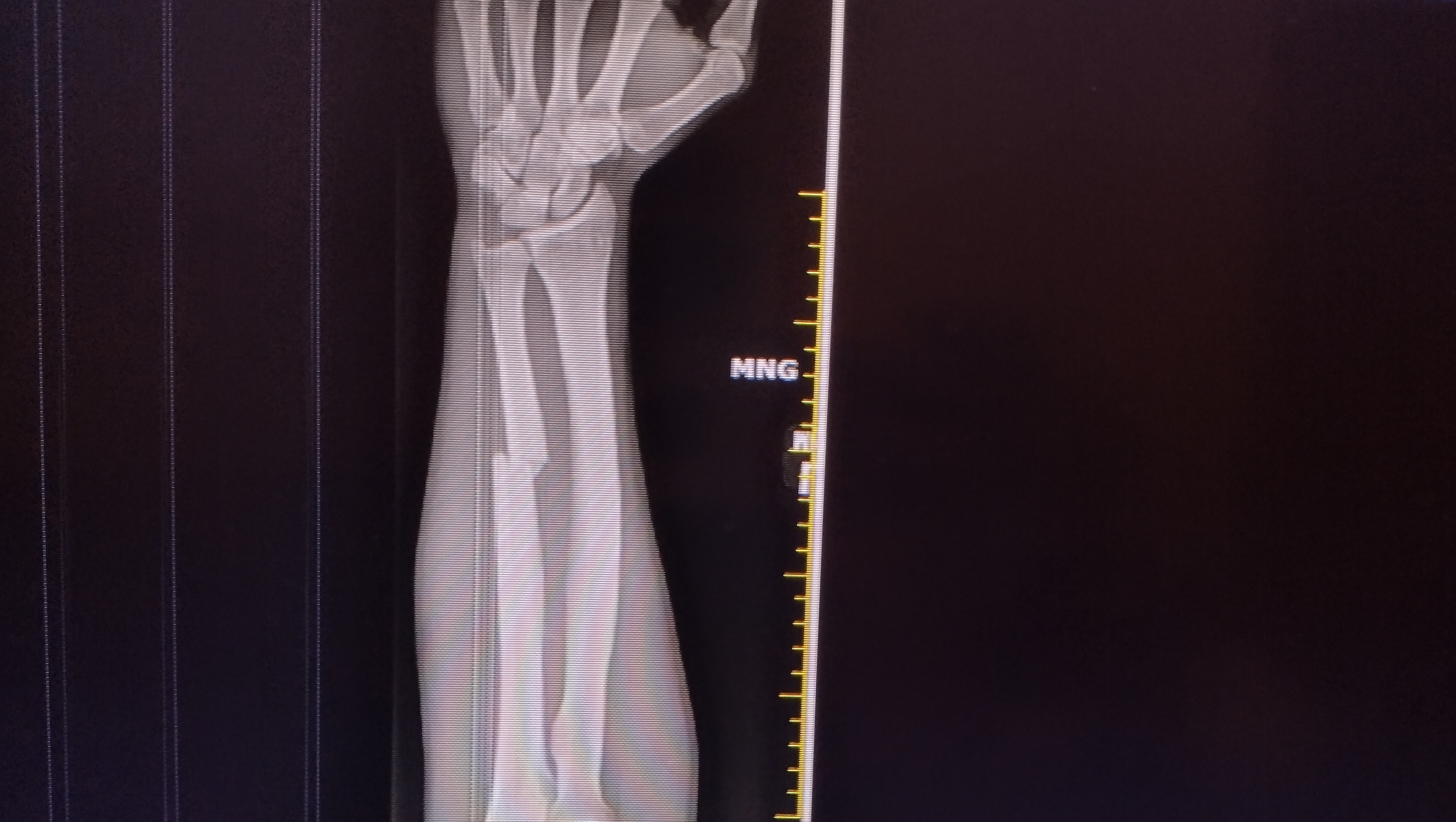 Fundraiser by Jeffrey Schley Need help paying for surgery