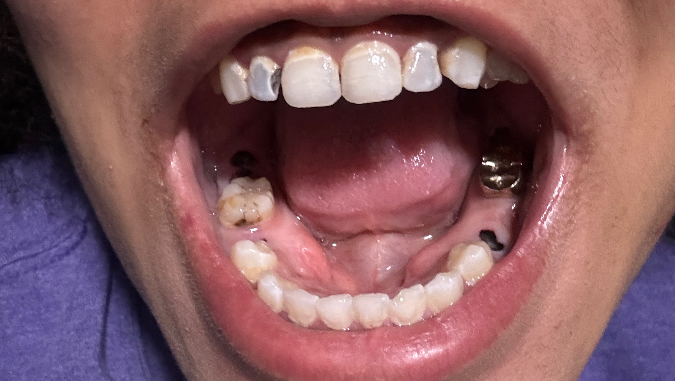 Dentures needed after child sexual abuse photo