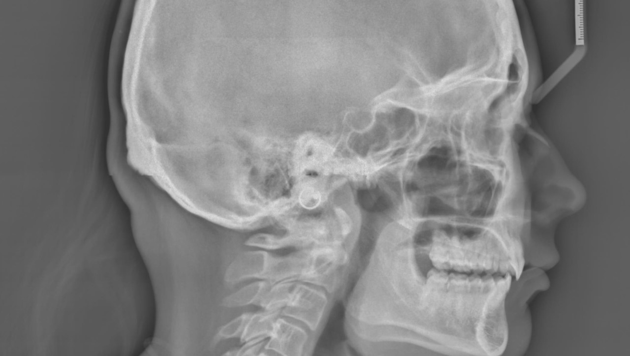 Fundraiser by Jenny Sadlier Medically necessary braces and jaw