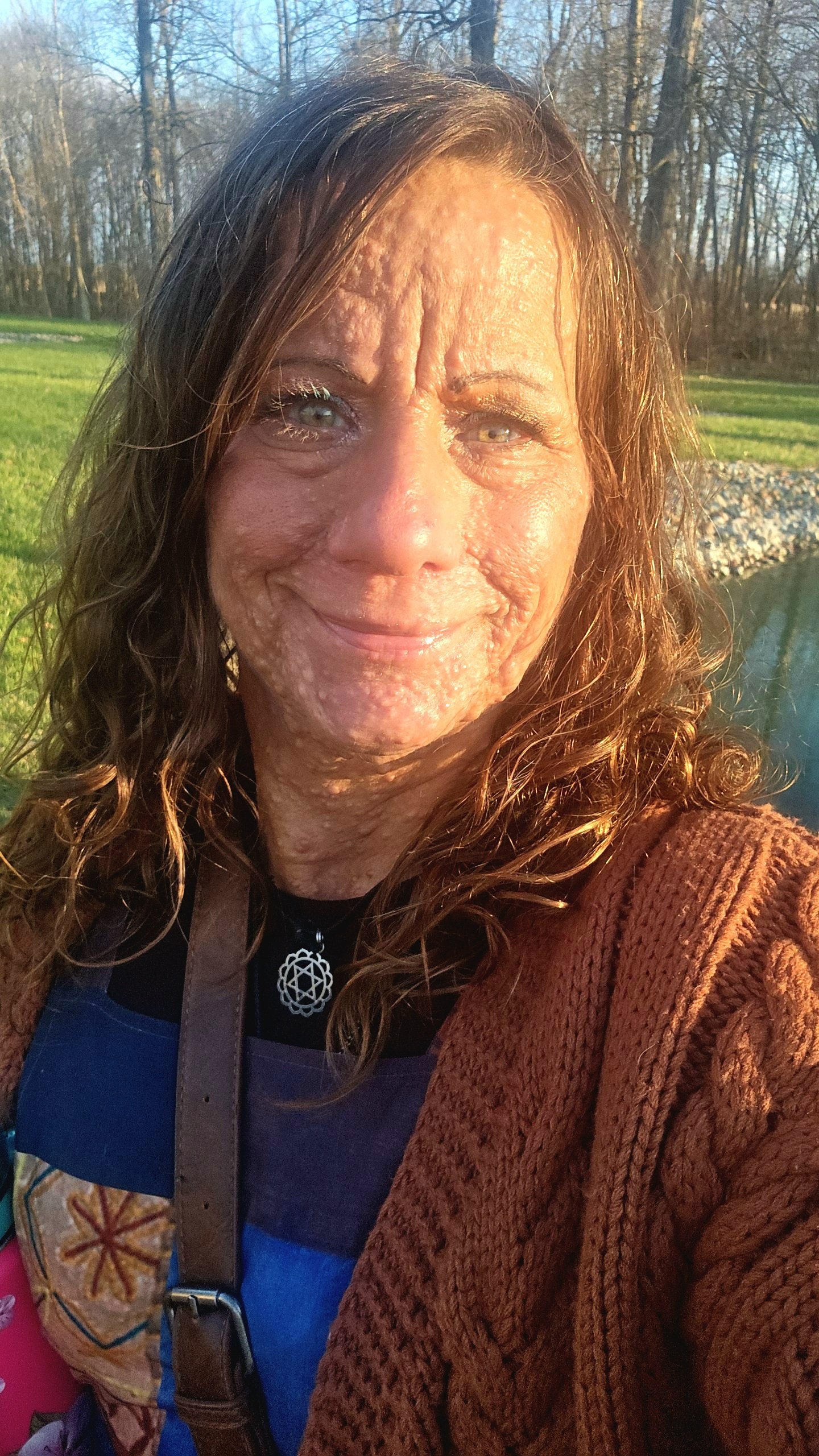 Seek travel assistance & co-pays for NF Surgery. campaign photo, 4 of 6