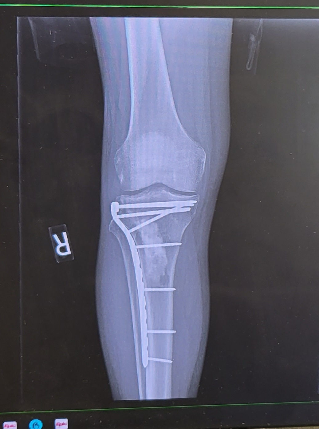 Fundraiser by John W : John's Hospital Bills: Really Broken Leg Edition, image size:1038x1393