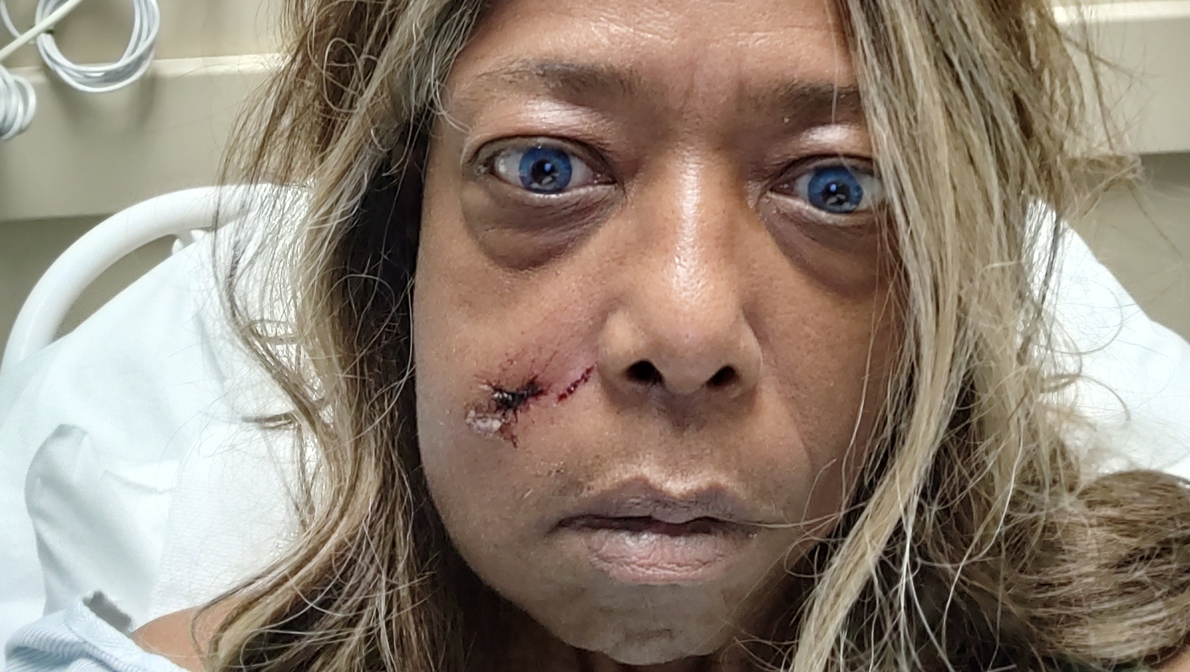 Fundraiser by Angela Floyd : Recent Injury Resulting In Facial Trauma