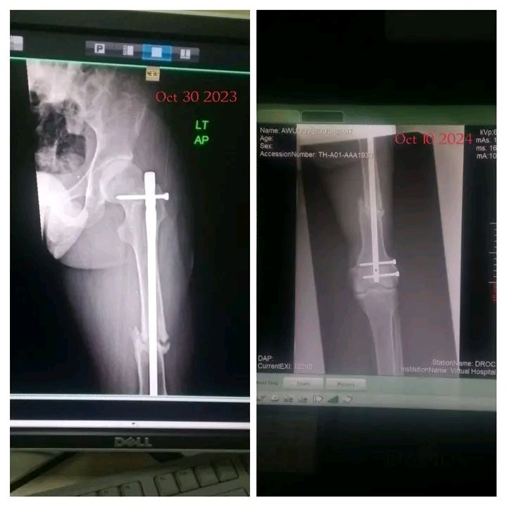 support me continue fighting for another chance to walk. campaign photo, 5 of 6