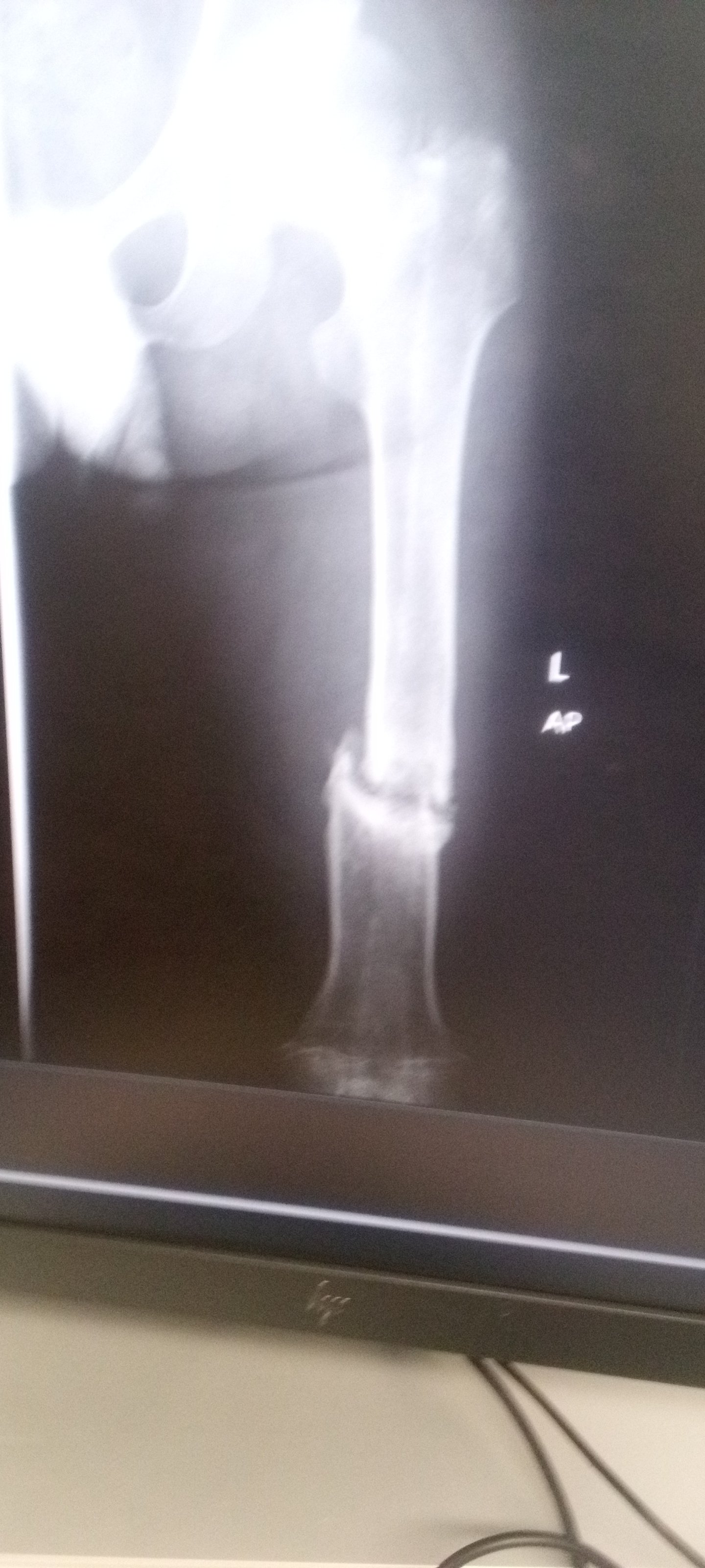 support me continue fighting for another chance to walk. campaign photo, 2 of 6