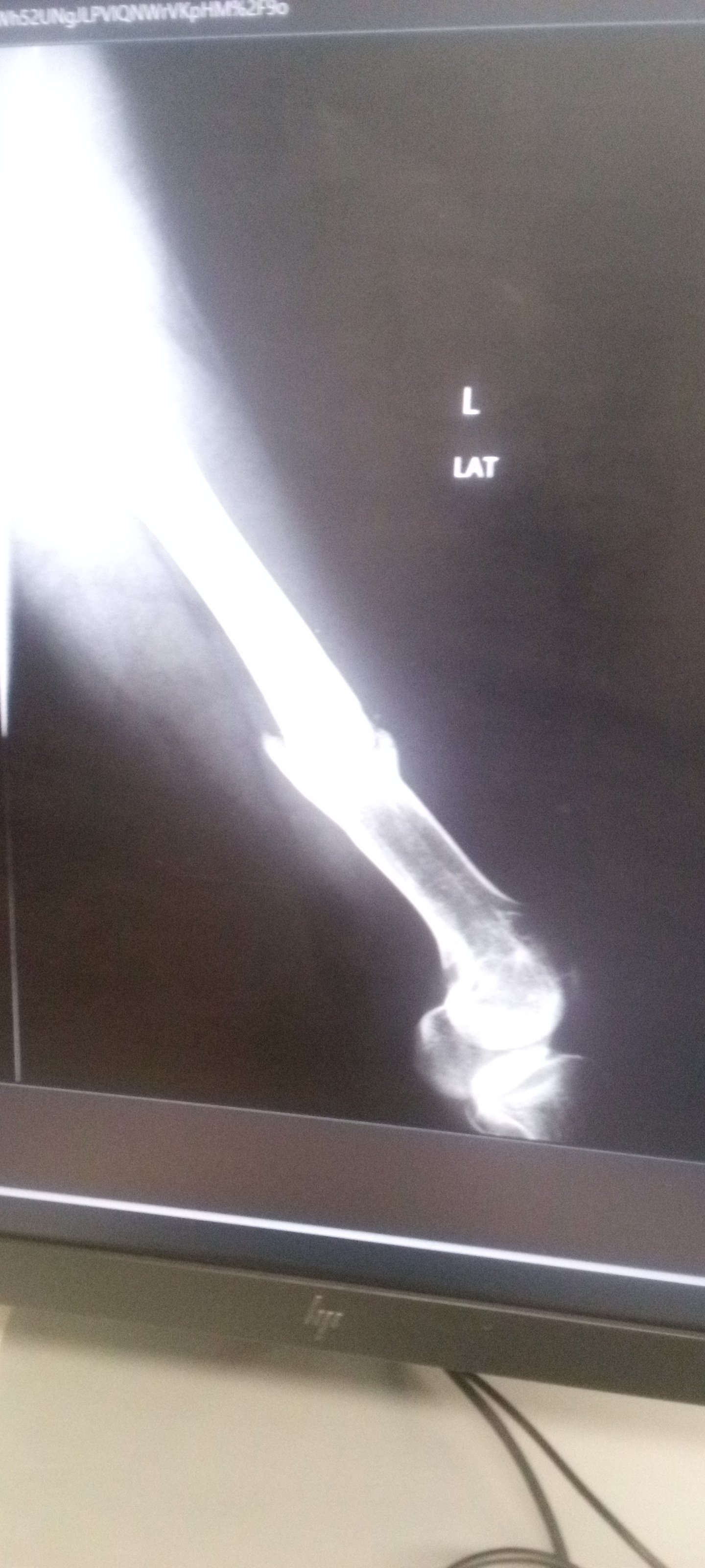 support me continue fighting for another chance to walk. campaign photo, 4 of 6