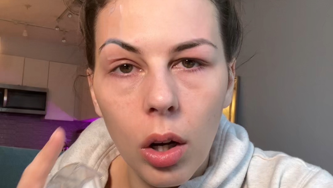 Fundraiser by Jessica Wetzstein : Eye Surgery for Jessica Wetz