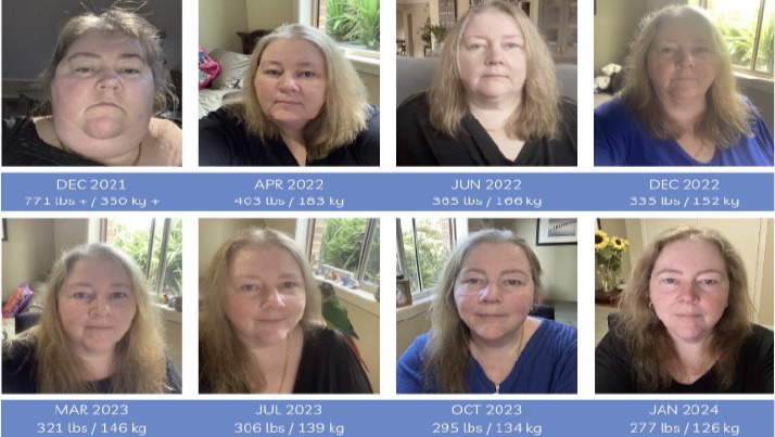 Limitless Lindys Skin Removal Surgery photo