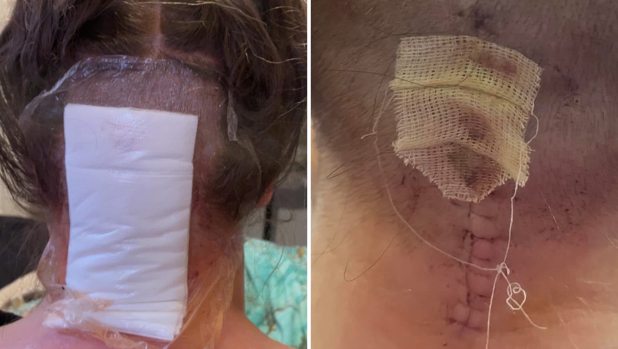 Nicole’s Recovery from brain surgery photo