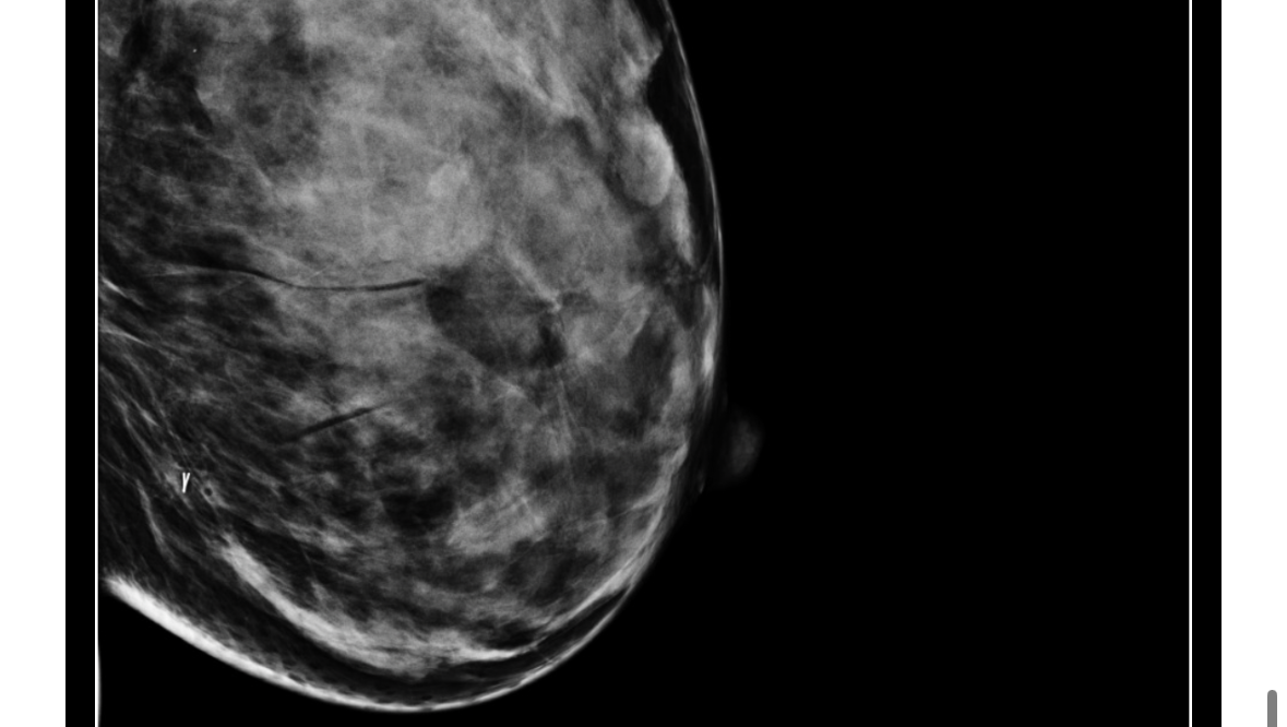 Help Queen in her Stage 3B Breast Cancer Fight photo