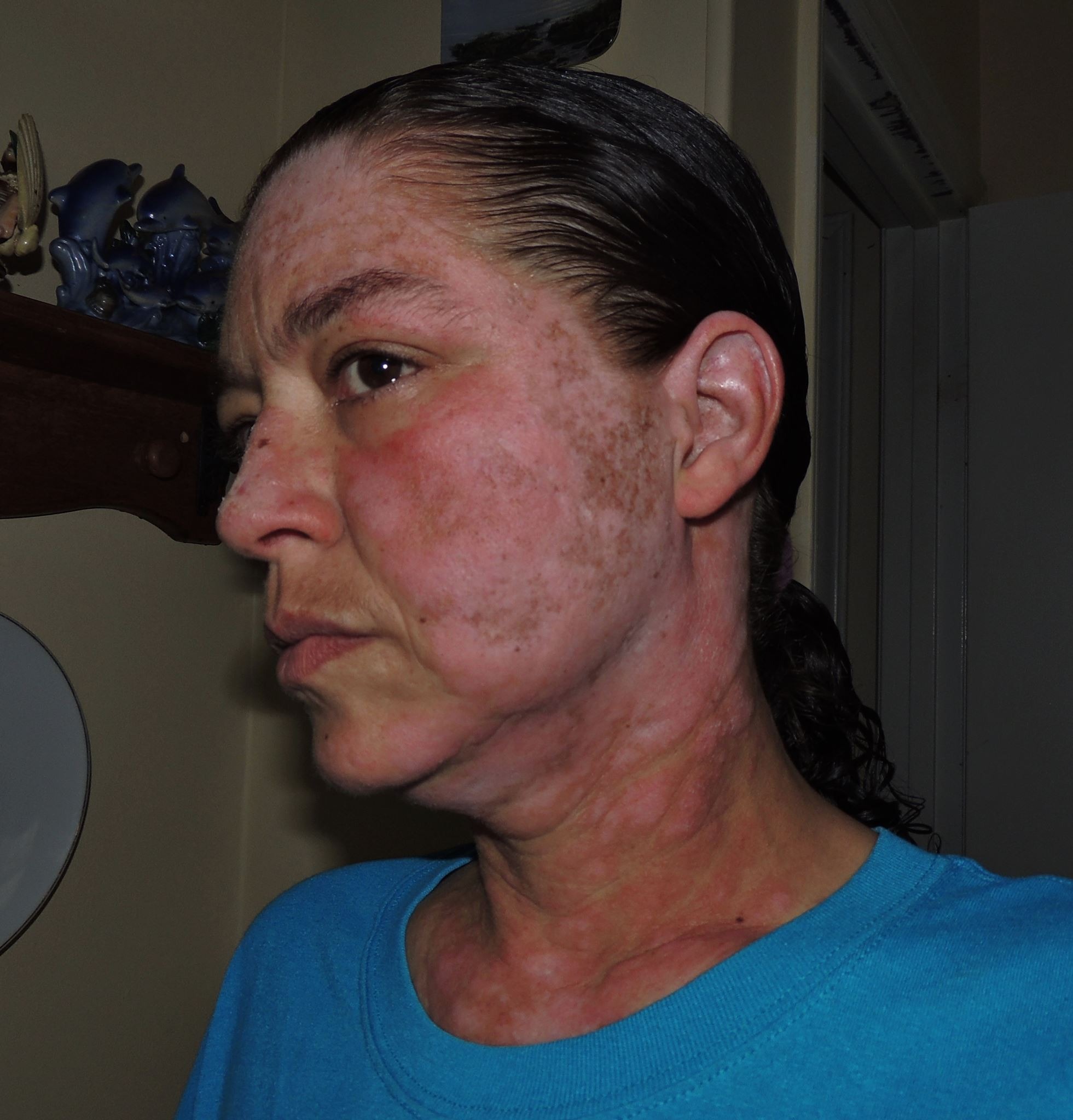 Dying For a Place to Call Home (Terminal Lupus) campaign photo, 5 of 7