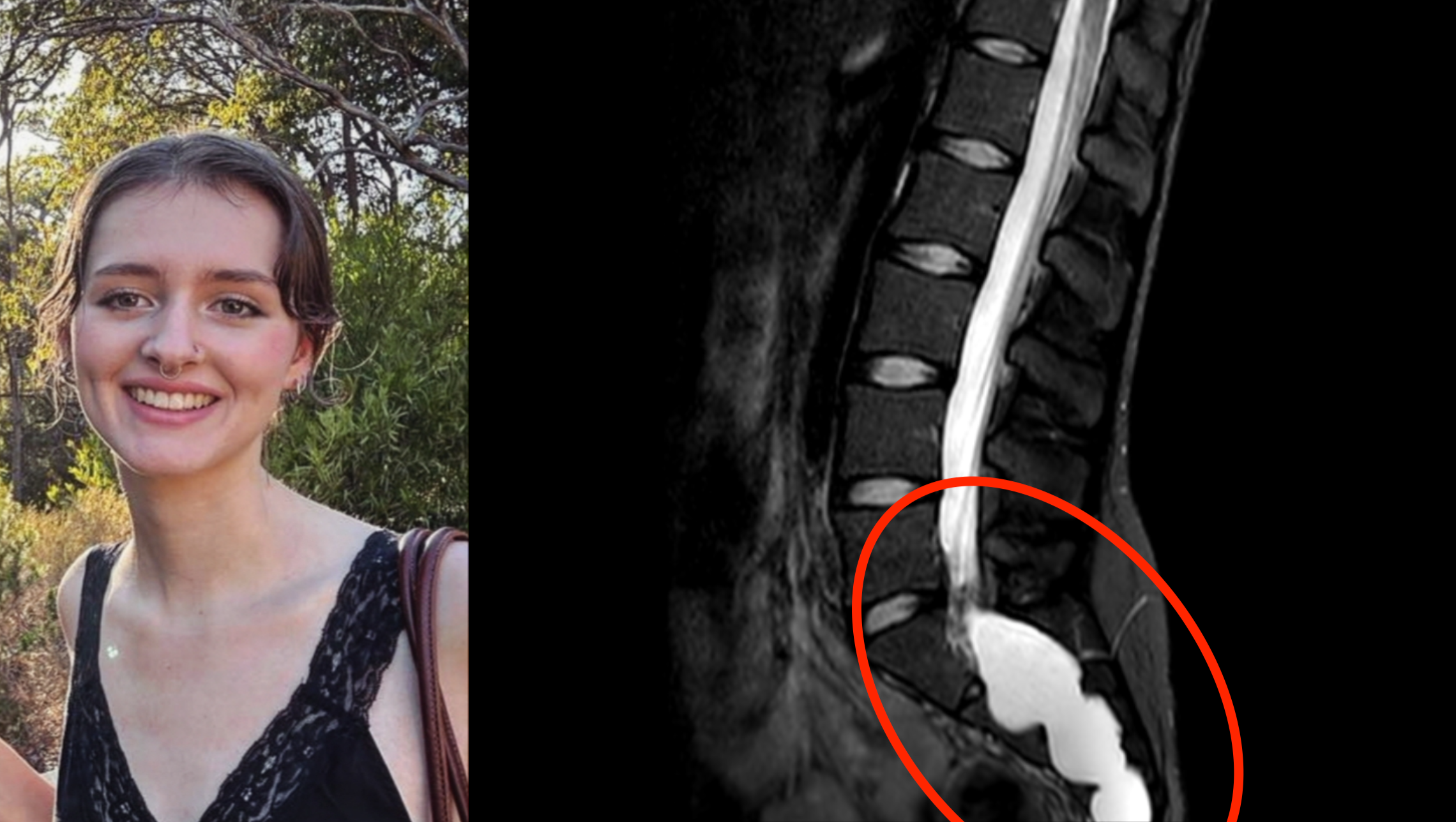 Grace's Rare Spinal Cyst photo