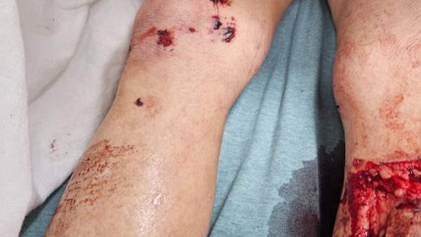 Help Teresa Scroggins Heal After Dog Attack photo