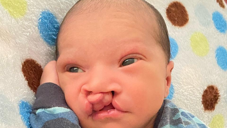 Help Baby West Get Life-Changing Surgery photo