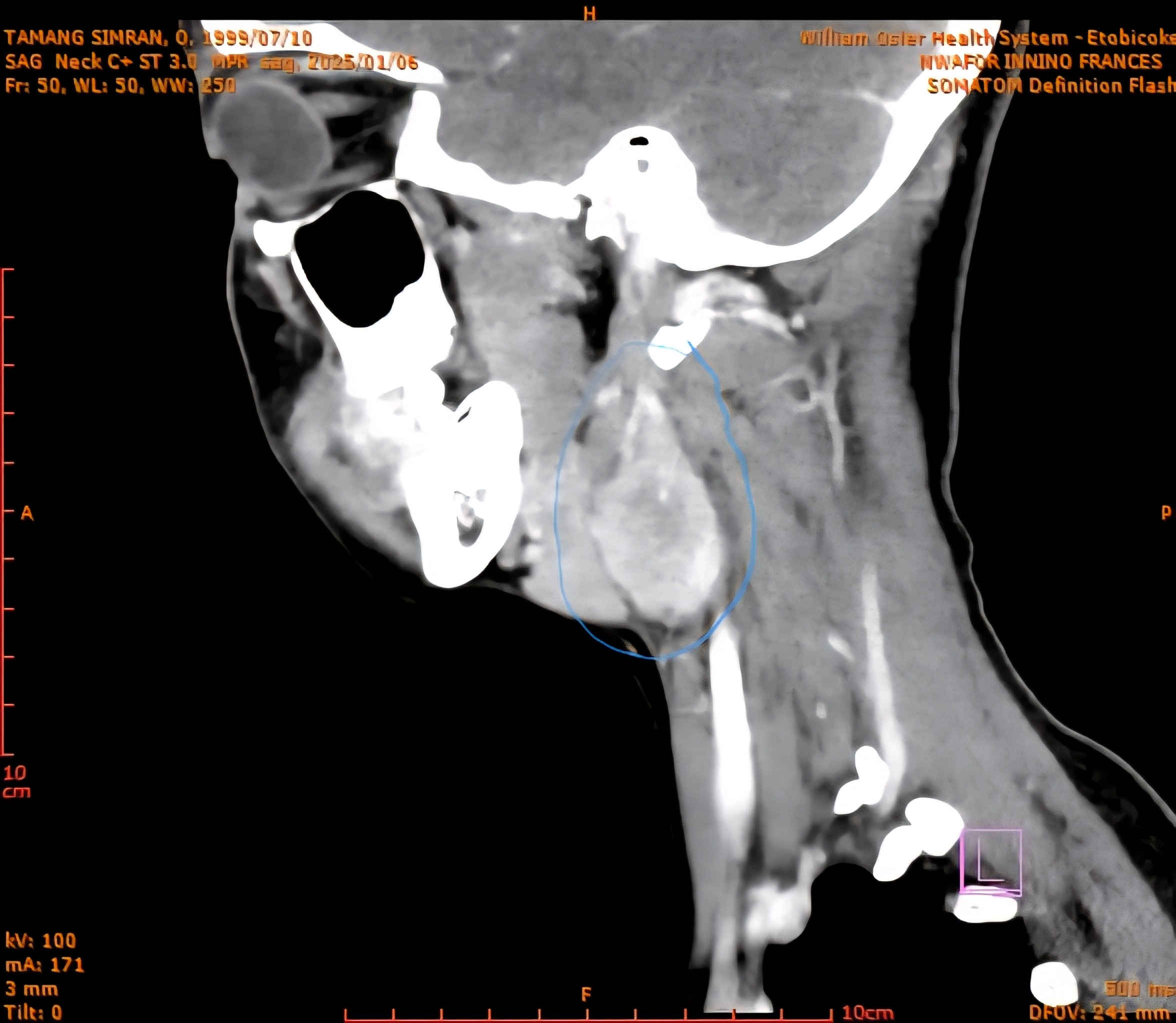 Help Simran Fight a Rare Paraganglioma Neck Tumor” campaign photo, 5 of 6