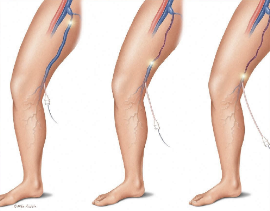 Help my Mother Lucia get Vein Surgery campaign photo, 2 of 4