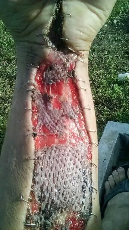 Foto de la recaudación de fondos SOLICITO AYUDA PARA UNA CIRUGÍA RECONSTRUCTIVA EN MIS BRAZOS, 6 de 8