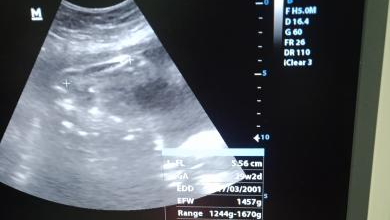 Help finance my friend's urgent surgery & help her recover photo