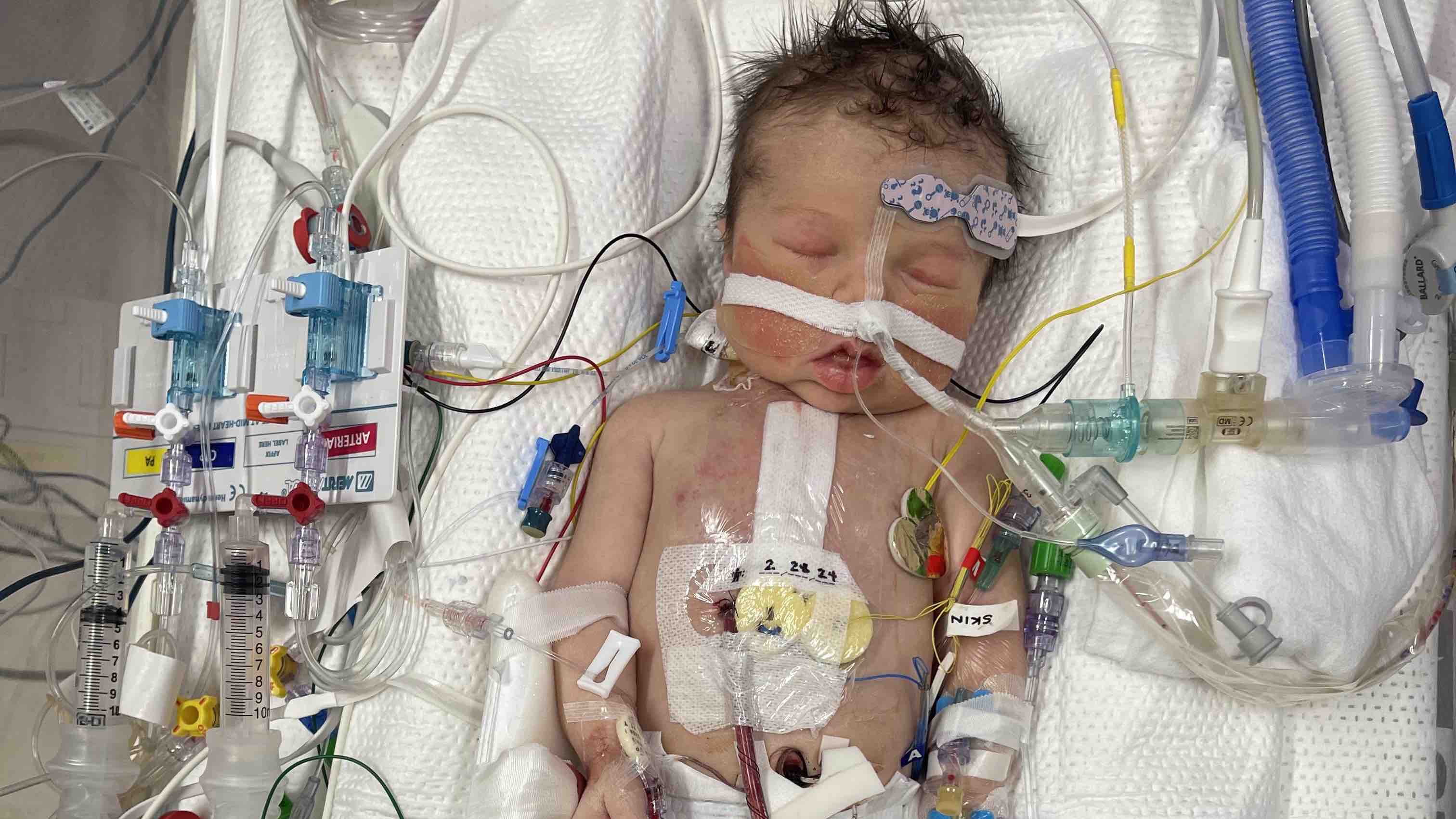 Alina’s Heart: One Last Surgery to Save Her Life photo