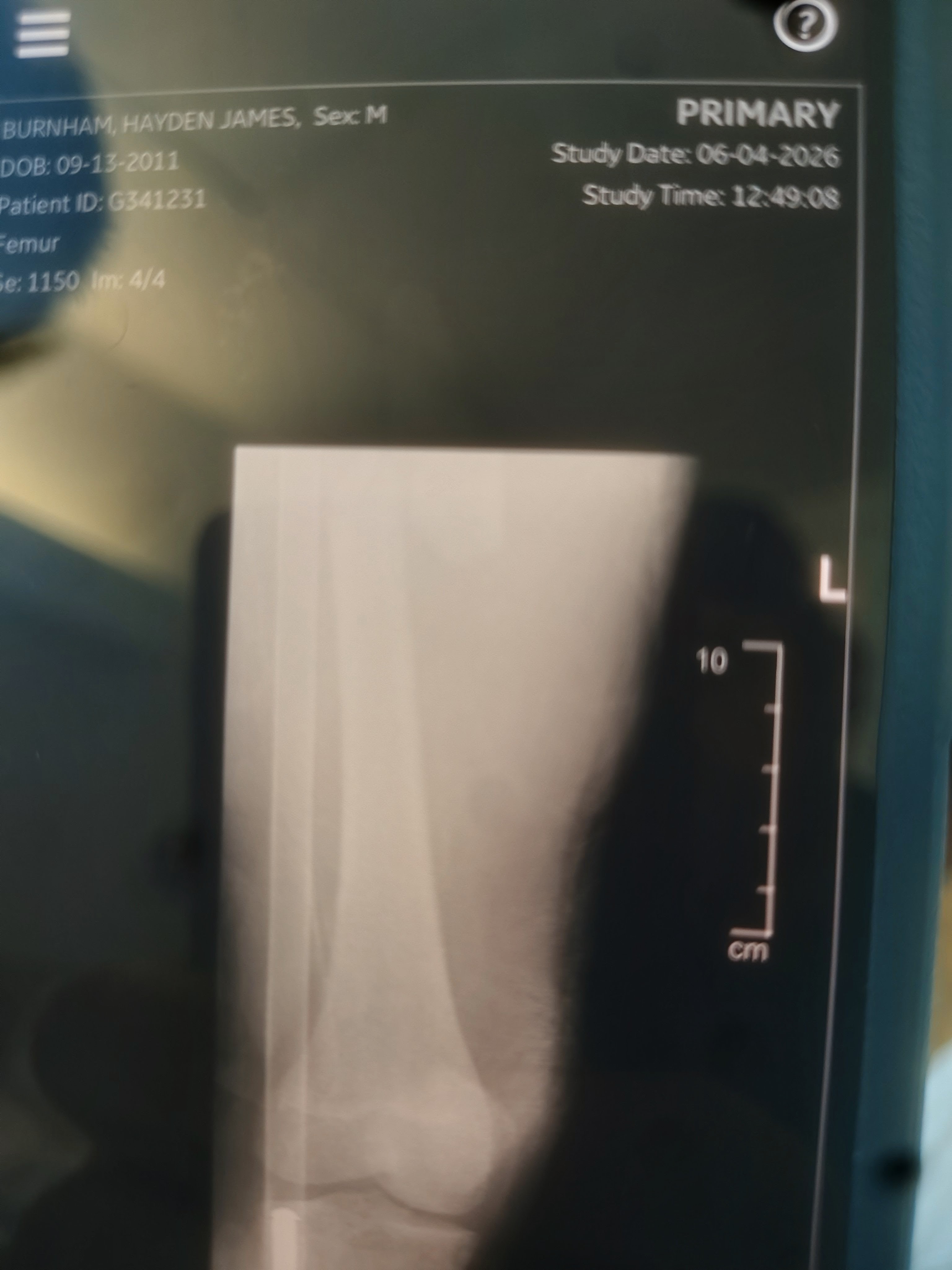 Hayden's Surgery and road to recovery campaign photo, 2 of 7