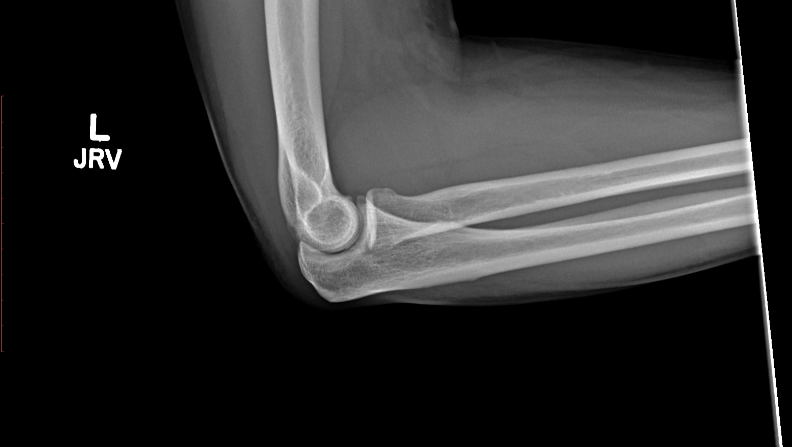 Ruptured Tendon: Your Help Needed for Healing photo